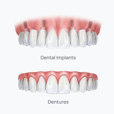 Implant-supported Denture vs. Traditional Denture