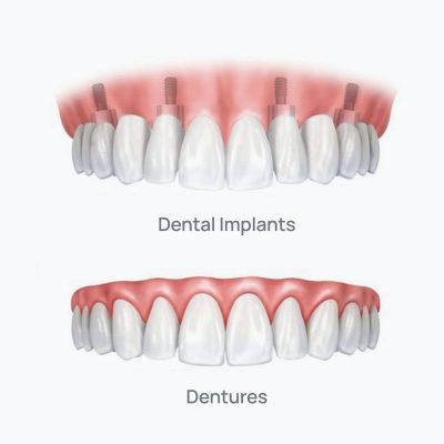 implant-vs.dentures